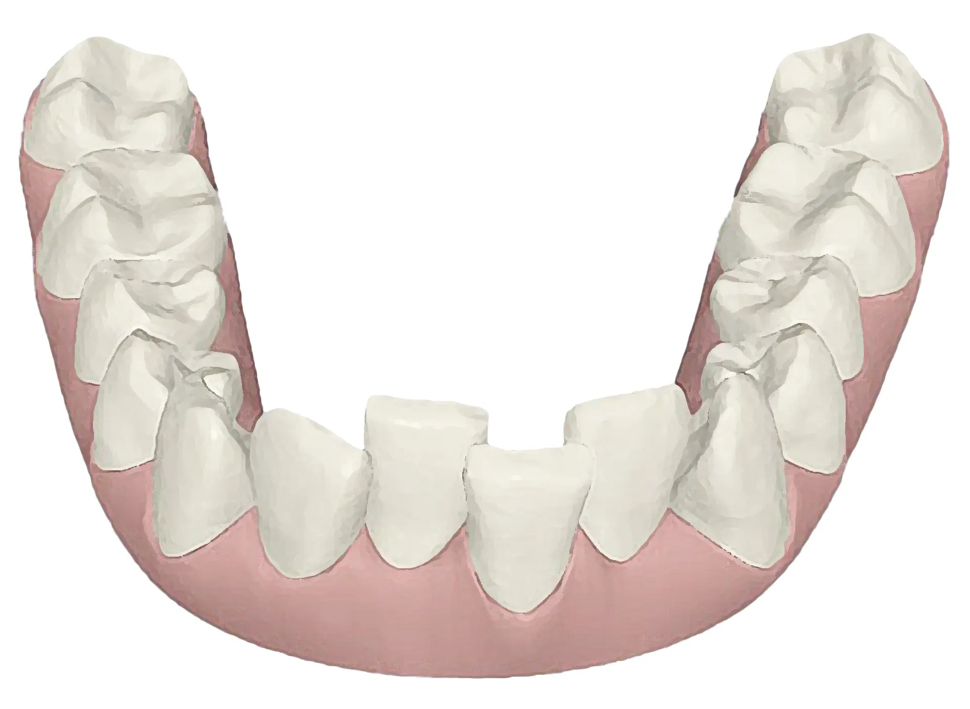 disegno dell'arcata inferiore dei denti prima del trattamento con allineatore trasparente